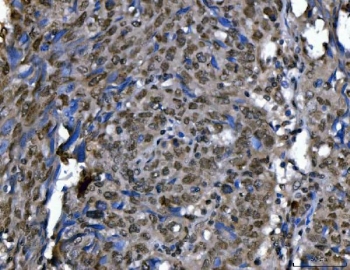 IHC staining of FFPE human lung cancer tissue with Ki-67 IHC antibody. HIER: boil tissue sections in pH8 EDTA for 20 min and allow to cool before testing.