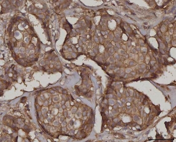 IHC staining of FFPE human breast cancer tissue with Synaptosomal-associated protein 23 antibody. HIER: boil tissue sections in pH8 EDTA for 20 min and allow to cool before testing.