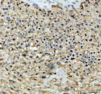 IHC staining of FFPE human placental tissue with STAT6 antibody, HRP-labeled secondary and DAB substrate. HIER: boil tissue sections in pH8 EDTA for 20 min and allow to cool before testing.