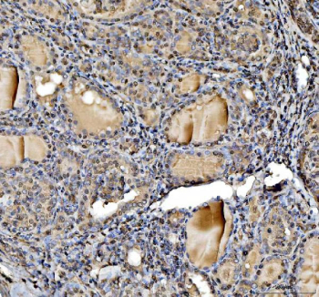 IHC staining of FFPE human thyroid cancer tissue with STAT6 antibody, HRP-labeled secondary and DAB substrate. HIER: boil tissue sections in pH8 EDTA for 20 min and allow to cool before testing.