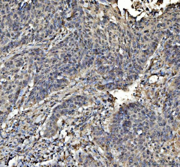 IHC staining of FFPE human laryngeal squamous cell carcinoma tissue with STAT6 antibody, HRP-labeled secondary and DAB substrate. HIER: boil tissue sections in pH8 EDTA for 20 min and allow to cool before testing.
