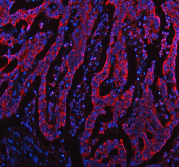 Immunofluorescent staining of FFPE human colon cancer tissue with TOMM20 antibody (red) and DAPI nuclear stain (blue). HIER: steam section in pH8 EDTA buffer for 20 min.