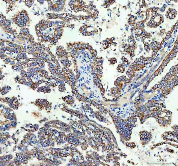 IHC staining of FFPE human lung cancer tissue with TOMM20 antibody. HIER: boil tissue sections in pH8 EDTA for 20 min and allow to cool before testing.