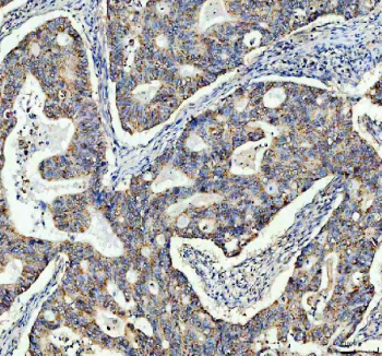 IHC staining of FFPE human colon cancer tissue with TOMM20 antibody. HIER: boil tissue sections in pH8 EDTA for 20 min and allow to cool before testing.