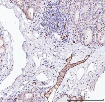 von Willebrand Factor Antibody / Hemostasis Research Antibody. Immunohistochemistry analysis of human thyroid cancer tissue shows HRP-DAB brown staining of endothelial cells lining vascular channels within the tumor microenvironment. The staining highlights irregular and branching vessel structures embedded within tumor stroma, with signal localized along endothelial surfaces consistent with VWF presence at the vascular interface. This pattern reflects vessel-associated regions involved in platelet interaction and coagulation factor support within neoplastic tissue. Endothelial-lined vessels are clearly distinguished from surrounding tumor cells and stromal components. HIER: boil tissue sections in pH8 EDTA for 20 min and allow to cool before testing.