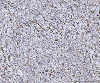 von Willebrand Factor Antibody / Hemostasis Research Antibody. Immunohistochemistry analysis of human renal cancer tissue shows HRP-DAB brown staining of endothelial cells forming an extensive network of vascular channels throughout the tumor microenvironment. The staining outlines numerous thin, branching vessel structures distributed between tumor cell clusters, with signal localized along endothelial surfaces consistent with VWF presence at the vascular interface. This pattern reflects widespread vascular involvement associated with platelet interaction and coagulation factor support within neoplastic tissue. Endothelial-lined vessels are clearly distinguished from surrounding tumor cells and stromal components. HIER: boil tissue sections in pH8 EDTA for 20 min and allow to cool before testing.