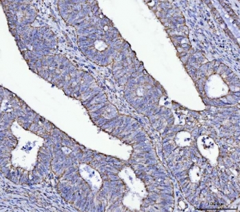 IHC staining of FFPE human endometrial adenocarcinoma tissue with ATP5A1 antibody. HIER: boil tissue sections in pH8 EDTA for 20 min and allow to cool before testing.