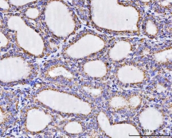 IHC staining of FFPE human thyroid cancer tissue with ATP5A1 antibody. HIER: boil tissue sections in pH8 EDTA for 20 min and allow to cool before testing.