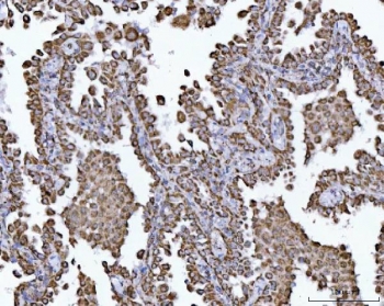 IHC staining of FFPE human lung cancer tissue with ECHS1 antibody. HIER: boil tissue sections in pH8 EDTA for 20 min and allow to cool before testing.