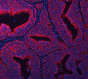 Immunofluorescent staining of FFPE human endometrial cancer tissue with RPL36 antibody (red) and DAPI nuclear stain (blue). HIER: steam section in pH8 EDTA buffer for 20 min.
