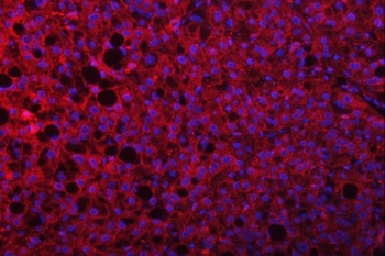 Immunofluorescent staining of FFPE human liver cancer tissue with SEPT9 antibody (red) and DAPI nuclear stain (blue). HIER: steam section in pH8 EDTA buffer for 20 min.