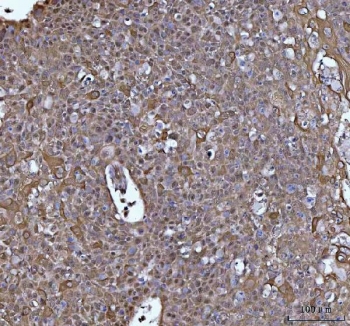 IHC staining of FFPE human esophageal squamous carcinoma tissue with TIP3 antibody. HIER: boil tissue sections in pH8 EDTA for 20 min and allow to cool before testing.