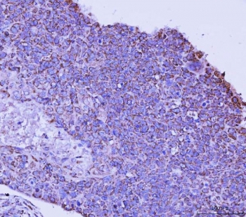 IHC staining of FFPE human esophageal squamous carcinoma tissue with Transcription factor EB antibody. HIER: boil tissue sections in pH8 EDTA for 20 min and allow to cool before testing.