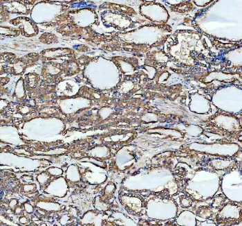 IHC staining of FFPE human thyroid cancer tissue with MARS1 antibody, HRP-labeled secondary and DAB substrate. HIER: boil tissue sections in pH8 EDTA for 20 min and allow to cool before testing.