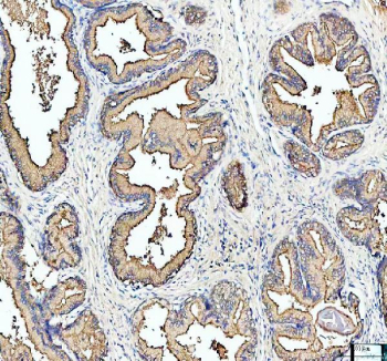 IHC staining of FFPE human prostate cancer tissue with MARS1 antibody, HRP-labeled secondary and DAB substrate. HIER: boil tissue sections in pH8 EDTA for 20 min and allow to cool before testing.