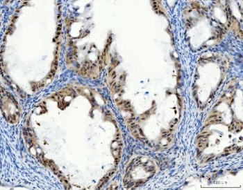 IHC staining of FFPE human ovarian cancer tissue with STK15 antibody. HIER: boil tissue sections in pH8 EDTA for 20 min and allow to cool before testing.