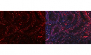 Immunofluorescent staining of FFPE human intestinal cancer tissue with PC4 antibody (red) and DAPI nuclear stain (blue). HIER: steam section in pH8 EDTA buffer for 20 min.