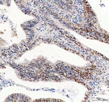 IHC staining of FFPE human endometrial adenocarcinoma tissue with Glycogen synthase kinase-3 beta antibody. HIER: boil tissue sections in pH8 EDTA for 20 min and allow to cool before testing.