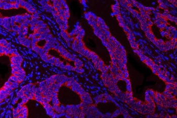 HBEGF Antibody Colorectal Adenocarcinoma IF. Immunofluorescence analysis of FFPE human colorectal adenocarcinoma tissue stained with HBEGF antibody (red) detecting Heparin-binding EGF-like growth factor (DT-R). Tumor epithelial structures show prominent membranous and cytoplasmic fluorescence, consistent with localization of HBEGF as a cell surface receptor capable of mediating diphtheria toxin binding and internalization, as well as EGFR ligand signaling. The staining pattern highlights carcinoma glands with enriched signal along epithelial cell borders. DAPI nuclear stain (blue) highlights nuclei. HIER: steam section in pH 8 EDTA buffer for 20 min.