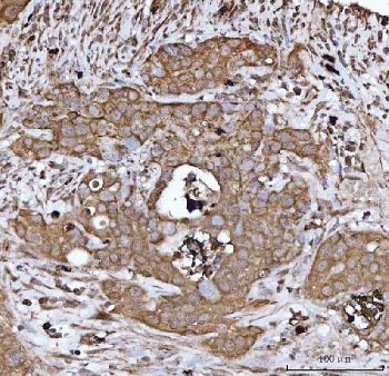 HBEGF Antibody Appendiceal Adenocarcinoma IHC. Immunohistochemistry analysis of FFPE human appendiceal adenocarcinoma tissue stained with HBEGF antibody detecting Heparin-binding EGF-like growth factor (DT-R). Tumor epithelial cells show membranous and cytoplasmic staining, consistent with localization of HBEGF as a cell surface receptor involved in diphtheria toxin binding and receptor-mediated internalization, as well as EGFR ligand signaling. The staining outlines glandular tumor structures, while surrounding stromal components show comparatively reduced signal. Hematoxylin counterstain highlights nuclei in blue. HIER: boil tissue sections in pH 8 EDTA for 20 min and allow to cool before testing.