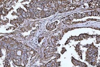 HBEGF Antibody Lung Adenocarcinoma IHC. Immunohistochemistry analysis of FFPE human lung adenocarcinoma tissue stained with HBEGF antibody detecting Heparin-binding EGF-like growth factor (DT-R). Tumor epithelial cells show membranous and cytoplasmic staining, consistent with localization of HBEGF as a cell surface receptor involved in diphtheria toxin binding and receptor-mediated internalization, as well as EGFR ligand signaling. The staining highlights glandular tumor architecture, while surrounding stromal elements show comparatively reduced signal. Hematoxylin counterstain highlights nuclei in blue. HIER: boil tissue sections in pH 8 EDTA for 20 min and allow to cool before testing.