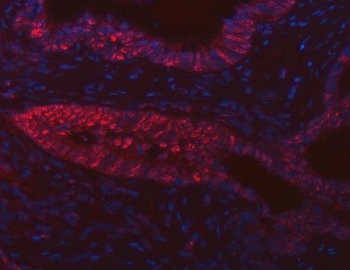Immunofluorescent staining of FFPE human colon cancer tissue with FIP1L1 antibody (red) and DAPI nuclear stain (blue). HIER: steam section in pH8 EDTA buffer for 20 min.