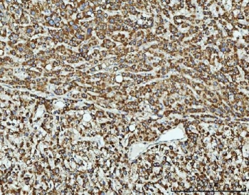 IHC staining of FFPE human liver cancer tissue with TOMM40 antibody. HIER: boil tissue sections in pH8 EDTA for 20 min and allow to cool before testing.