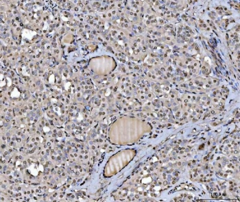 IHC staining of FFPE human thyroid cancer tissue with hnRNP U antibody. HIER: boil tissue sections in pH8 EDTA for 20 min and allow to cool before testing.