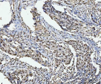 IHC staining of FFPE human laryngeal squamous cell carcinoma tissue with HNRPL antibody. HIER: boil tissue sections in pH8 EDTA for 20 min and allow to cool before testing.