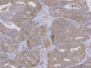 IHC staining of FFPE human endometrial adenocarcinoma tissue with BI-1 antibody. HIER: boil tissue sections in pH8 EDTA for 20 min and allow to cool before testing.
