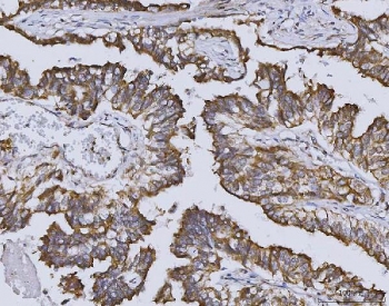 IHC staining of FFPE human lung squamous cell carcinoma tissue with HO-2 antibody. HIER: boil tissue sections in pH8 EDTA for 20 min and allow to cool before testing.