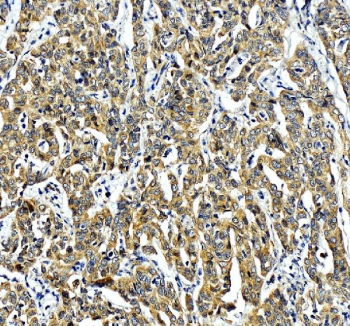 IHC staining of FFPE human liver cancer tissue with ERGIC1 antibody, HRP-labeled secondary and DAB substrate. HIER: boil tissue sections in pH8 EDTA for 20 min and allow to cool before testing.