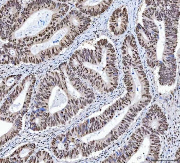IHC staining of FFPE human colorectal adenocarcinoma tissue with X-ray repair cross-complementing 4 antibody. HIER: boil tissue sections in pH8 EDTA for 20 min and allow to cool before testing.