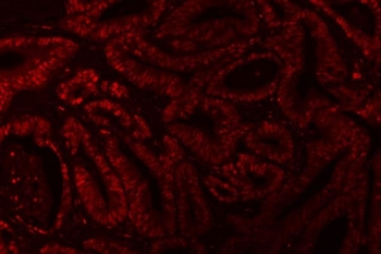 Immunofluorescent staining of FFPE human colorectal adenocarcinoma tissue with X-ray repair cross-complementing 4 antibody. HIER: boil tissue sections in pH8 EDTA for 20 min and allow to cool before testing.