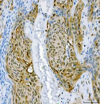 IHC staining of FFPE human squamous cell carcinoma of the penis with PSF antibody. HIER: boil tissue sections in pH8 EDTA for 20 min and allow to cool before testing.