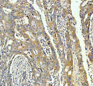 INF2 Antibody Human Colon Cancer IHC. Immunohistochemistry staining of FFPE human colon cancer tissue with INF2 Antibody at 2 ug/ml. HIER was performed using pH 8 EDTA buffer, followed by blocking with 10% goat serum. The tissue section was incubated with rabbit anti-INF2 antibody overnight at 4Â°C, followed by HRP-conjugated goat anti-rabbit IgG secondary antibody and DAB chromogen detection. INF2 Antibody / Actin Regulation Protein Antibody demonstrates cytoplasmic staining consistent with Inverted Formin 2 expression and supports studies of actin cytoskeleton remodeling, intracellular organization and cell structure regulation pathways.
