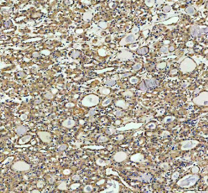 INF2 Antibody Human Thyroid Cancer IHC. Immunohistochemistry staining of FFPE human thyroid cancer tissue with INF2 Antibody at 2 ug/ml. HIER was performed using pH 8 EDTA buffer, followed by blocking with 10% goat serum. The tissue section was incubated with rabbit anti-INF2 antibody overnight at 4Â°C, followed by HRP-conjugated goat anti-rabbit IgG secondary antibody and DAB chromogen detection. INF2 Antibody / Actin Regulation Protein Antibody demonstrates cytoplasmic staining consistent with Inverted Formin 2 expression and supports studies of actin cytoskeleton remodeling, intracellular organization and cell structure regulation pathways.