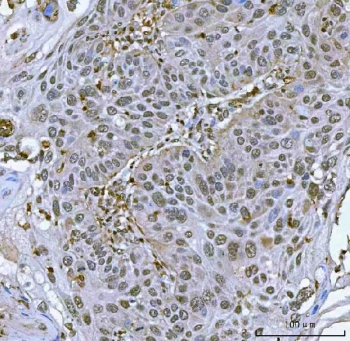 IHC staining of FFPE human laryngeal squamous cell carcinoma tissue with Tip110 antibody. HIER: boil tissue sections in pH8 EDTA for 20 min and allow to cool before testing.