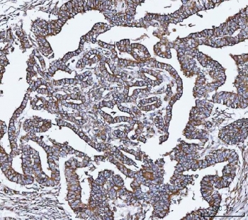 VAPA Antibody Cervical Cancer IHC. Immunohistochemistry staining of FFPE human cervical cancer tissue using VAPA Antibody / ER Membrane Contact Site Protein demonstrates moderate to strong HRP-DAB brown staining throughout malignant epithelial cell populations. The observed staining pattern is predominantly membranous and cytoplasmic, consistent with expression of Vesicle-Associated Membrane Protein-Associated Protein A (VAPA), an endoplasmic reticulum-associated protein involved in membrane contact site formation, intracellular trafficking, and organelle communication. Staining highlights tumor-associated epithelial structures and supports evaluation of VAPA expression and localization in human cervical cancer tissue. Heat-induced epitope retrieval was performed by boiling tissue sections in pH 8 EDTA buffer for 20 minutes followed by cooling prior to staining.