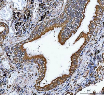 VAPA Antibody Lung Adenocarcinoma IHC. Immunohistochemistry staining of FFPE human lung adenocarcinoma tissue using VAPA Antibody / ER Membrane Contact Site Protein demonstrates strong HRP-DAB brown staining within malignant glandular epithelial cells. The observed staining pattern is predominantly membranous and cytoplasmic, consistent with expression of Vesicle-Associated Membrane Protein-Associated Protein A (VAPA), an endoplasmic reticulum-associated protein involved in membrane contact site formation, intracellular trafficking, lipid transport, and organelle communication. Staining prominently outlines neoplastic glandular structures and supports evaluation of VAPA expression and localization in human lung adenocarcinoma tissue. Heat-induced epitope retrieval was performed by boiling tissue sections in pH 8 EDTA buffer for 20 minutes followed by cooling prior to staining.