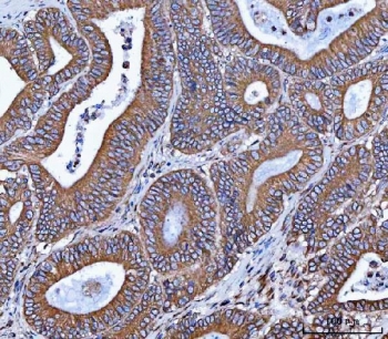VAPA Antibody Colorectal Adenocarcinoma IHC. Immunohistochemistry staining of FFPE human colorectal adenocarcinoma tissue using VAPA Antibody / ER Membrane Contact Site Protein demonstrates strong HRP-DAB brown staining throughout malignant glandular epithelial cell populations. The observed staining pattern is predominantly membranous and cytoplasmic, consistent with expression of Vesicle-Associated Membrane Protein-Associated Protein A (VAPA), an endoplasmic reticulum-associated protein involved in membrane contact site formation, intracellular trafficking, lipid transport, and organelle communication. Staining prominently highlights neoplastic glandular structures and supports evaluation of VAPA expression and localization in human colorectal adenocarcinoma tissue. Heat-induced epitope retrieval was performed by boiling tissue sections in pH 8 EDTA buffer for 20 minutes followed by cooling prior to staining.