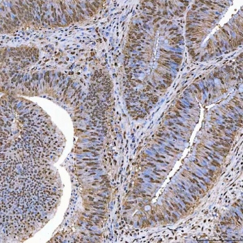 IHC staining of FFPE human colorectal adenocarcinoma tissue with SART1 antibody. HIER: boil tissue sections in pH8 EDTA for 20 min and allow to cool before testing.