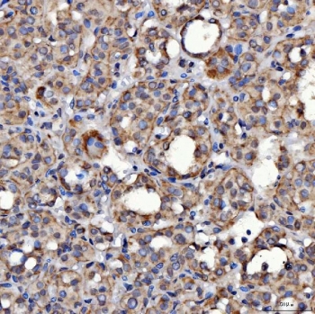 IHC staining of FFPE human thyroid cancer tissue with SerRS antibody. HIER: boil tissue sections in pH8 EDTA for 20 min and allow to cool before testing.