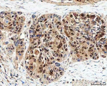 IHC staining of FFPE human esophageal squamous carcinoma tissue with SDE2 antibody. HIER: boil tissue sections in pH8 EDTA for 20 min and allow to cool before testing.