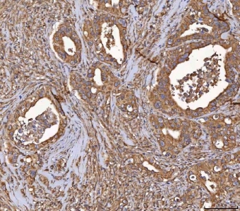 IHC staining of FFPE human appendix cancer tissue with HSD11K antibody. HIER: boil tissue sections in pH8 EDTA for 20 min and allow to cool before testing.