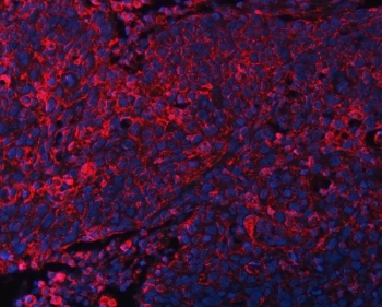 DOCK1 Antibody Esophageal Squamous Cell Carcinoma IF. Immunofluorescent staining of FFPE human esophageal squamous cell carcinoma tissue using DOCK1 Antibody / Cell Migration Protein Antibody demonstrates widespread cytoplasmic and membranous staining (red) throughout malignant epithelial cell populations, consistent with expression of Dedicator of Cytokinesis 1 (DOCK1). DOCK1 is a Rac guanine nucleotide exchange factor that regulates cell migration, cytoskeletal remodeling, and cellular adhesion through activation of Rac-dependent signaling pathways. The observed staining pattern is consistent with the established role of DOCK1 in coordinating dynamic cellular behavior and tissue organization. DAPI nuclear stain (blue) identifies cell nuclei and provides contrast to the predominantly cytoplasmic distribution of DOCK1. HIER: boil tissue sections in pH8 EDTA for 20 min and allow to cool before testing.