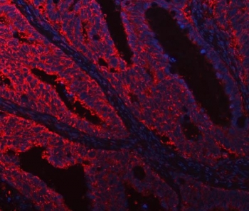 DOCK1 Antibody Human Intestinal Cancer IF. Immunofluorescent staining of FFPE human intestinal cancer tissue using DOCK1 Antibody / Cell Migration Protein Antibody demonstrates widespread cytoplasmic staining (red) throughout malignant epithelial and stromal-associated cellular compartments, consistent with expression of Dedicator of Cytokinesis 1 (DOCK1). DOCK1 is a Rac guanine nucleotide exchange factor that regulates cell migration, cytoskeletal remodeling, cellular adhesion, and signaling pathways involved in tissue organization. The extensive staining pattern is consistent with the established role of DOCK1 in coordinating dynamic cellular interactions and motility-associated processes within complex tissue microenvironments. DAPI nuclear stain (blue) identifies cell nuclei and provides contrast to the predominantly cytoplasmic distribution of DOCK1. HIER: boil tissue sections in pH8 EDTA for 20 min and allow to cool before testing.