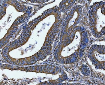 DOCK1 Antibody Human Colorectal Adenocarcinoma IHC. Immunohistochemistry staining of FFPE human colorectal adenocarcinoma tissue using DOCK1 Antibody / Cell Migration Protein Antibody demonstrates strong cytoplasmic and membranous staining within malignant gland-forming epithelial cells, consistent with expression of Dedicator of Cytokinesis 1 (DOCK1). DOCK1 is a Rac guanine nucleotide exchange factor that regulates cell migration, cytoskeletal remodeling, cellular adhesion, and tissue organization through activation of Rac-dependent signaling pathways. The observed staining pattern is consistent with the established role of DOCK1 in coordinating dynamic cellular behavior and interactions with the surrounding microenvironment. These findings support the utility of DOCK1 antibody for studies of cell migration, cytoskeletal regulation, and signaling pathways involved in tissue architecture and cellular motility. HIER: boil tissue sections in pH8 EDTA for 20 min and allow to cool before testing.