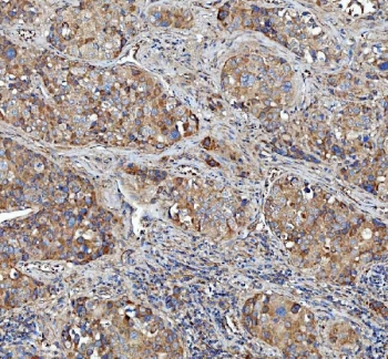 IHC staining of FFPE human liver cancer tissue with FERMT2 antibody. HIER: boil tissue sections in pH8 EDTA for 20 min and allow to cool before testing.