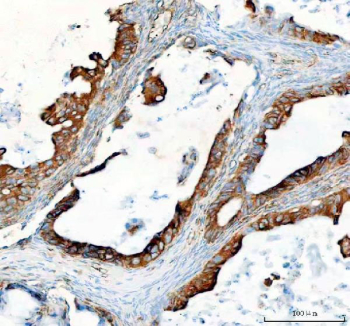 IHC staining of FFPE human ovarian serous adenocarcinoma tissue with SEC22B antibody. HIER: boil tissue sections in pH8 EDTA for 20 min and allow to cool before testing.